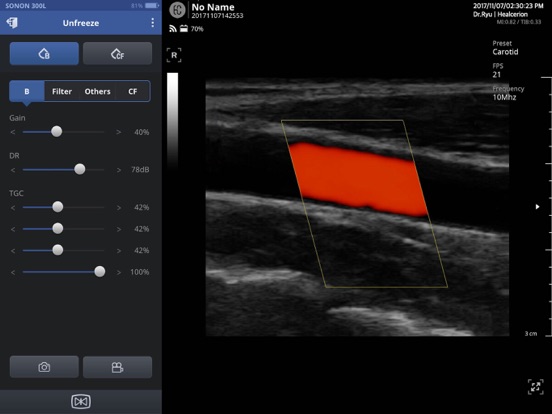 Screenshot #4 pour SONON Ultrasound App