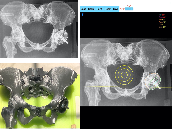 CupAnteversionInclinationApp