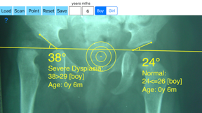 AcetabularIndex screenshot