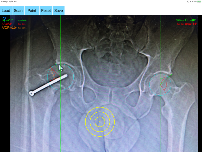 FemoroAcetabularImpingementApp