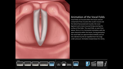 Vocal Pathology: Polyps Screenshot