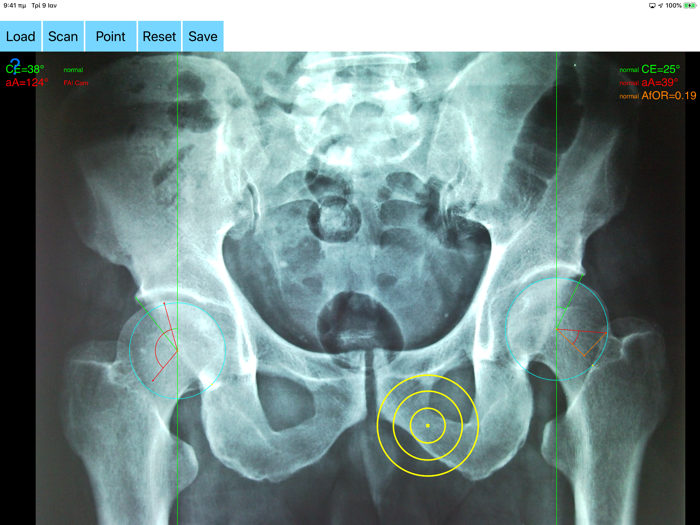 FemoroAcetabularImpingementApp