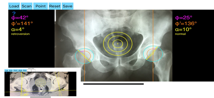 AcetabularAnteversionApp