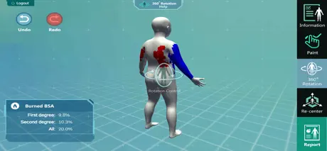 3D PED Burn Resuscitation