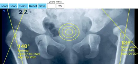 NeckShaftAngle App