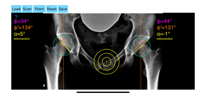 AcetabularAnteversionApp
