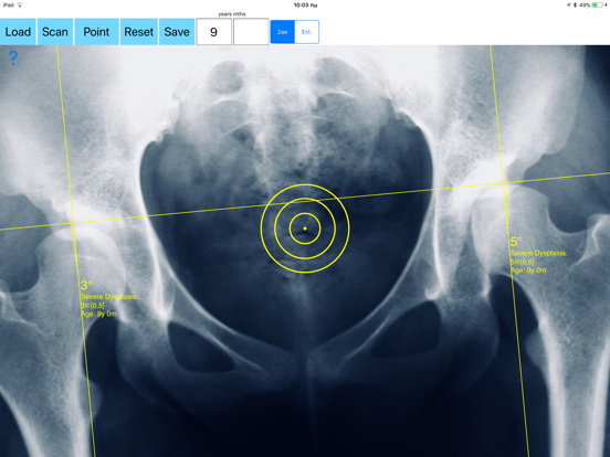 Screenshot #6 pour CenterEdgeAngleApp