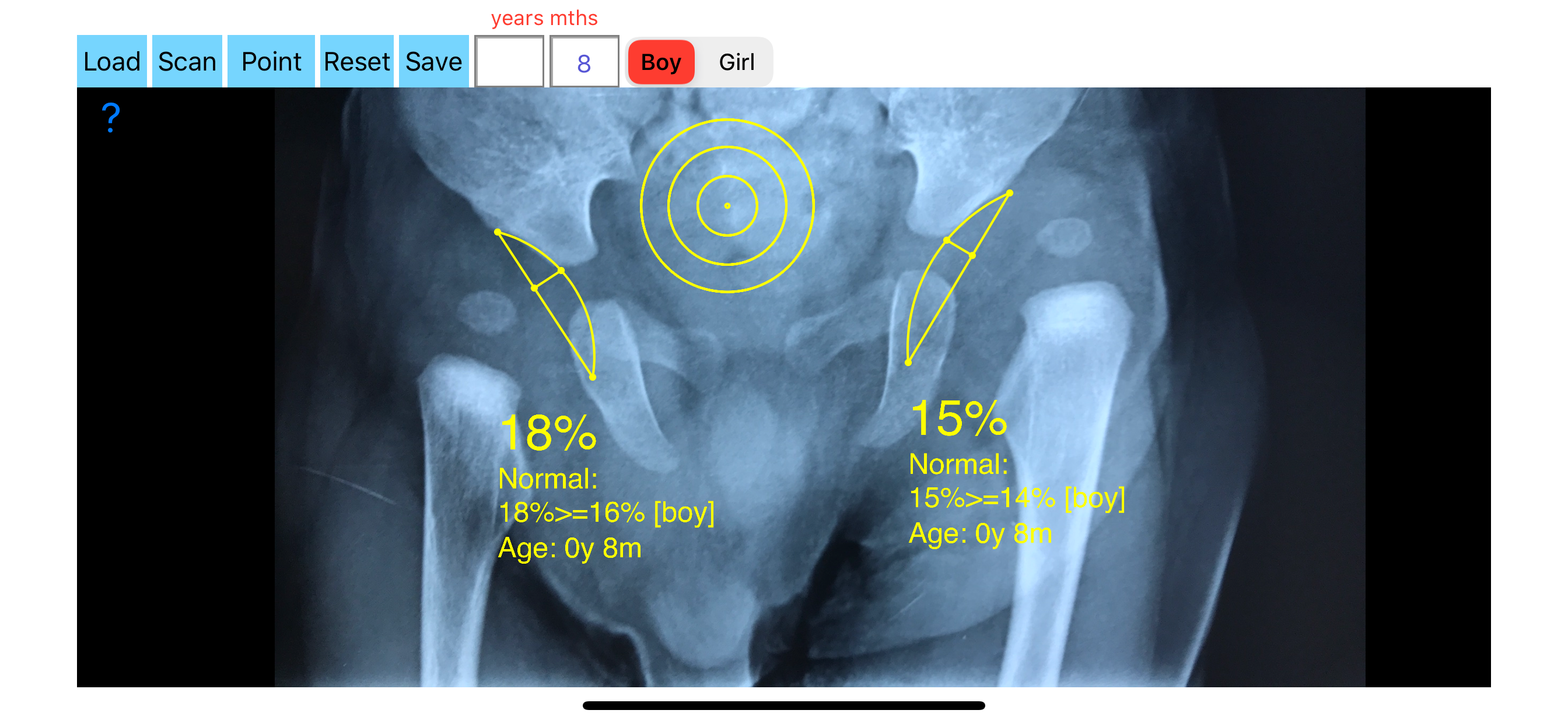 AcetabularDepthRatioApp screenshot 11
