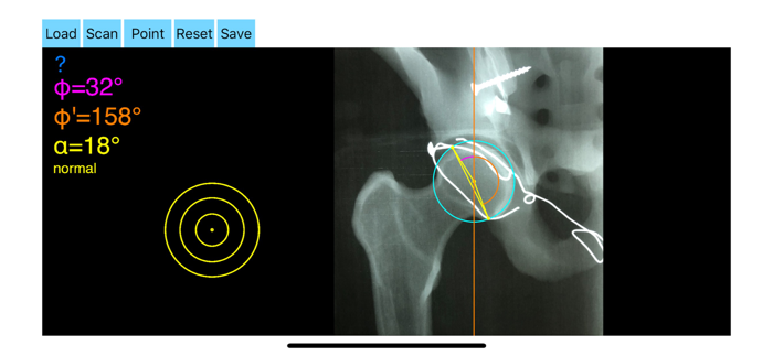 AcetabularAnteversionApp