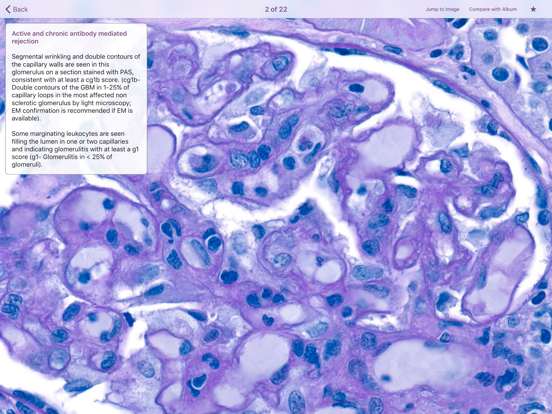 Screenshot #6 pour Renal Transplant Pathology