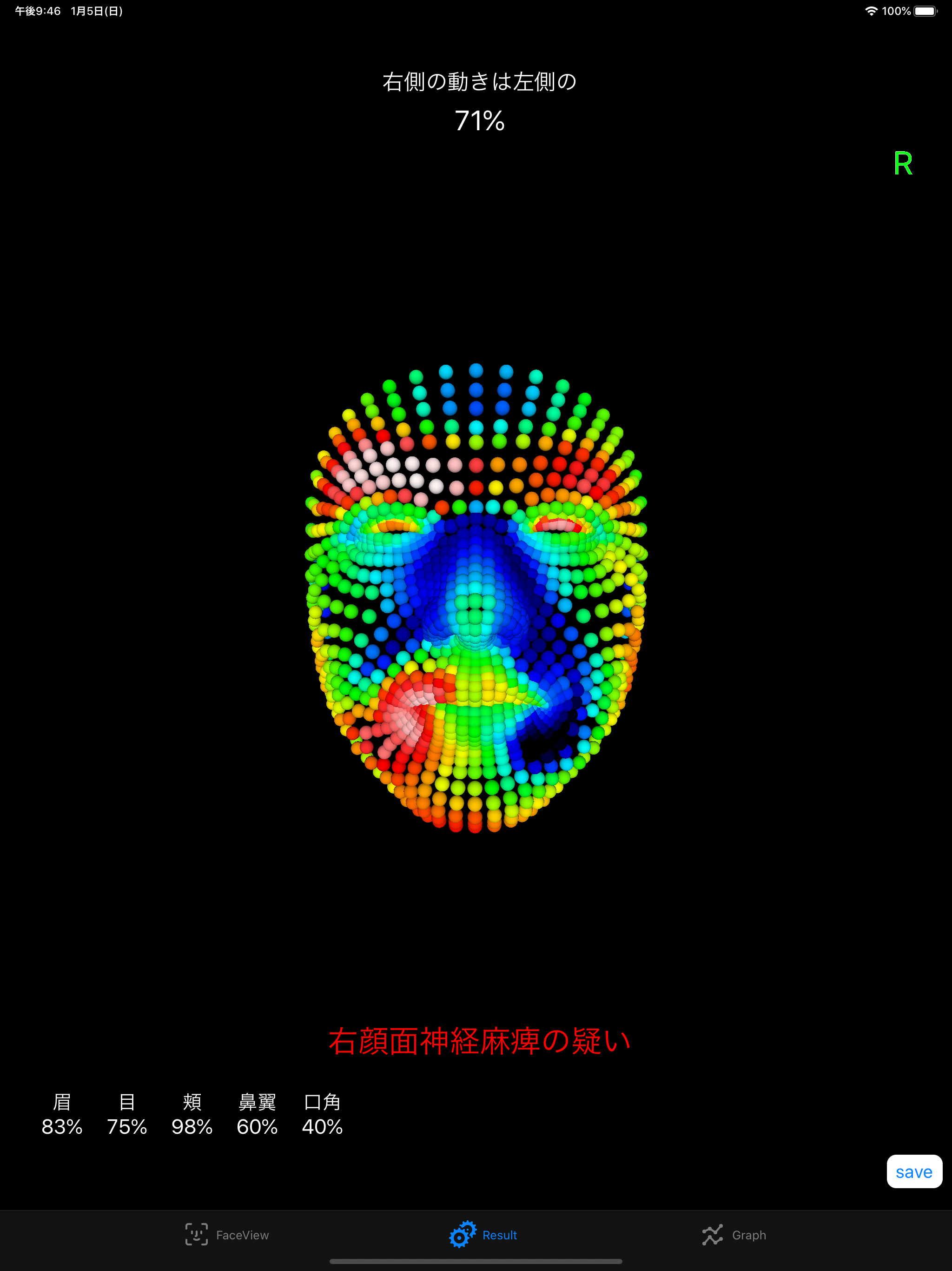 FacialPalsyZero screenshot 4