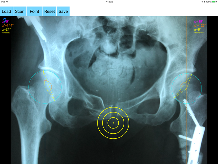AcetabularAnteversionApp