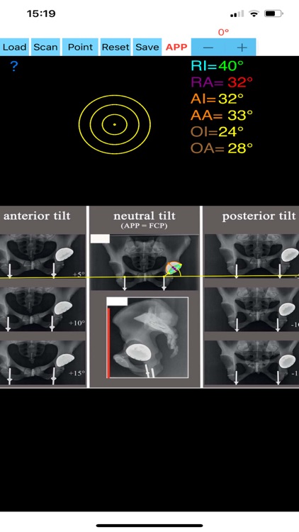 CupAnteversionInclinationApp screenshot-3