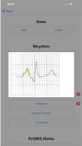 EKG DDX screenshot