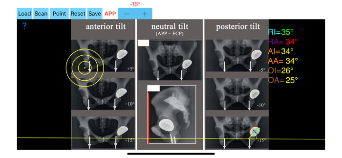 CupAnteversionInclinationApp