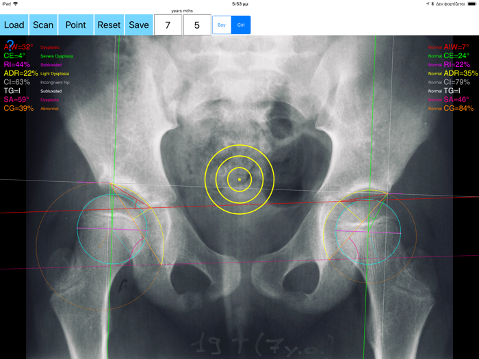 HipDysplasiaApp