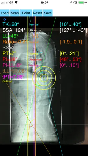 Screenshot von SagittalBalanceApp auf dem iPhone 2