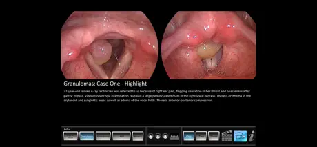 Vocal Pathology: Reflux