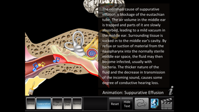Screenshot #2 pour Otitis Media Disorders