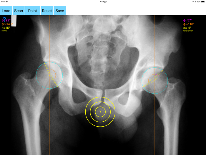 AcetabularAnteversionApp