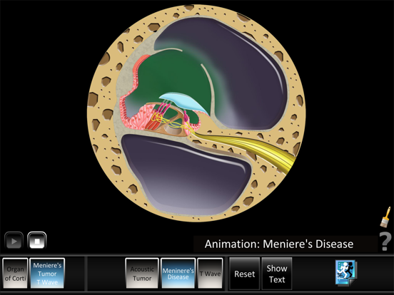 Screenshot #5 pour Ear Disorders: Inner