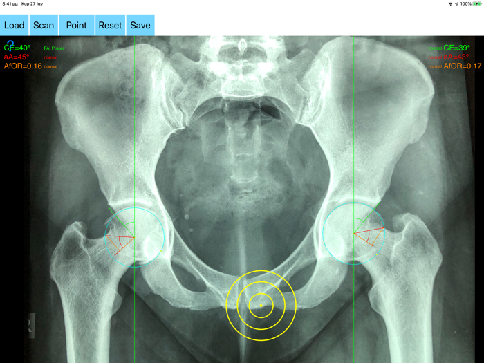 FemoroAcetabularImpingementApp