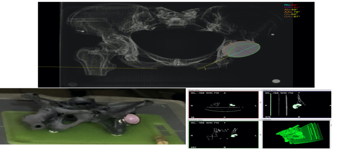 CupAnteversionInclinationApp