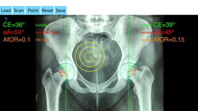 FemoroAcetabularImpingementApp screenshot 2