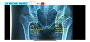 AcetabularDepthRatioApp screenshot #8 for iPhone
