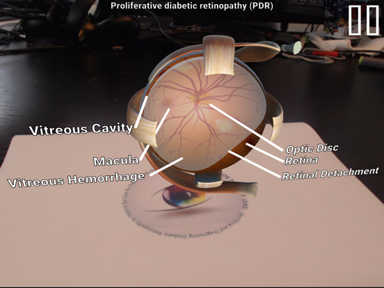 Screenshot #5 pour Diabetic Retinopathy AR