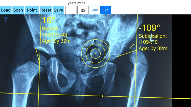 CenterEdgeAngleApp screenshot-3