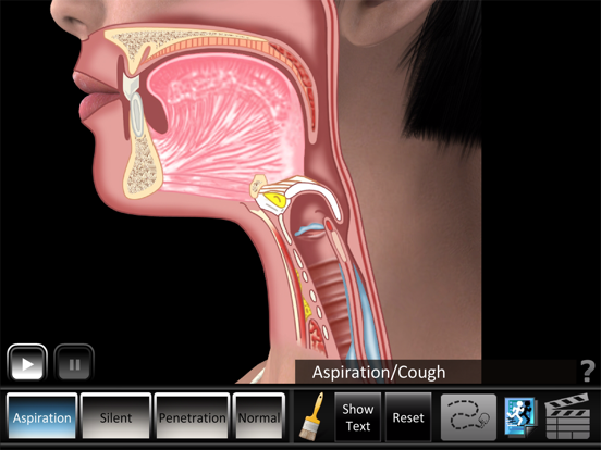 Screenshot #6 pour Aspiration Disorders