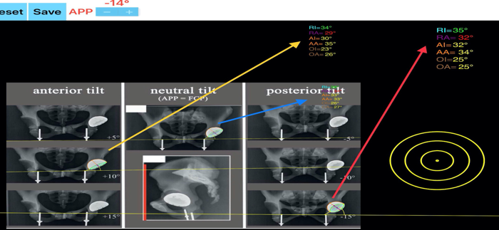 CupAnteversionInclinationApp