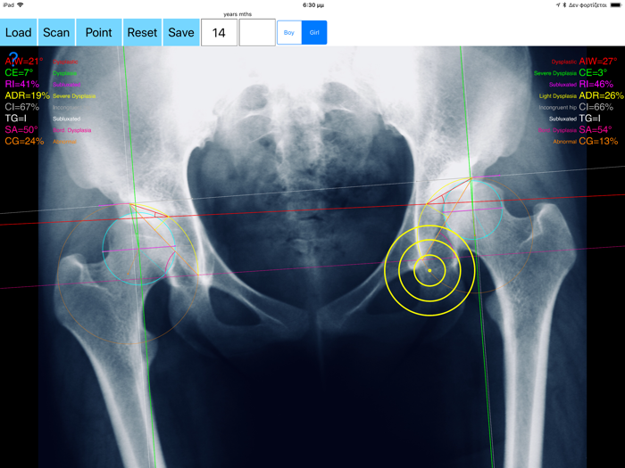 HipDysplasiaApp