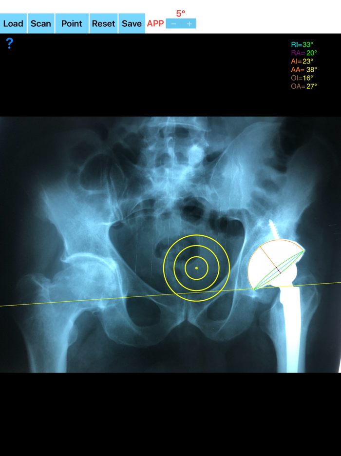 CupAnteversionInclinationApp