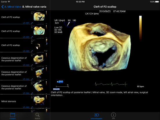 CARDIO3®3D Echocardiography HDのおすすめ画像4