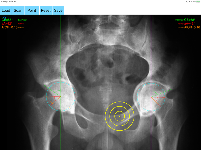 FemoroAcetabularImpingementApp