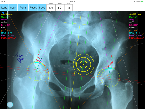 Screenshot #4 pour HipBiomechanicsApp
