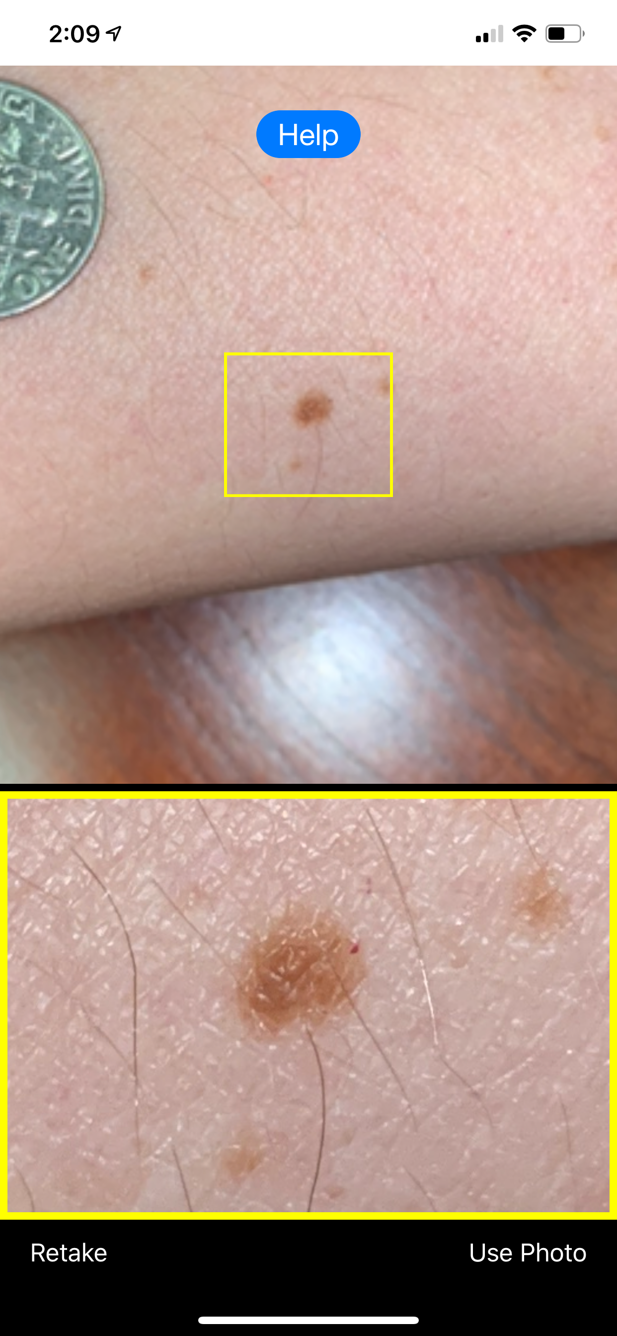 Mole Mapper Melanoma Study