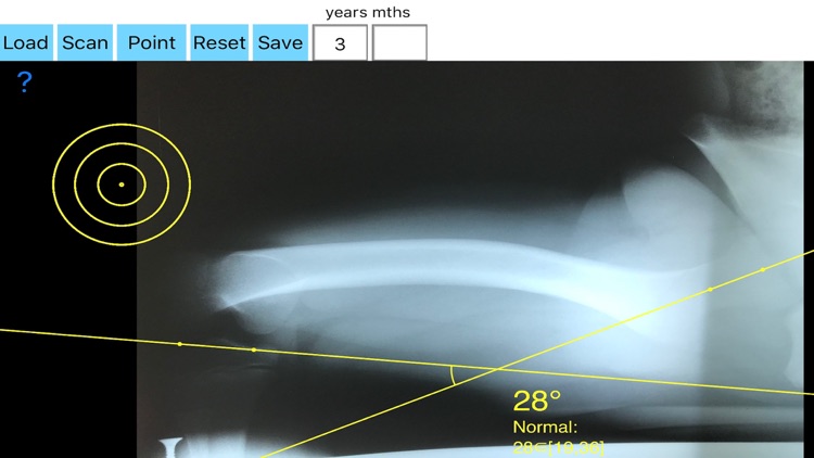 FemoralAnteversionApp screenshot-4