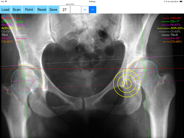 HipDysplasiaApp