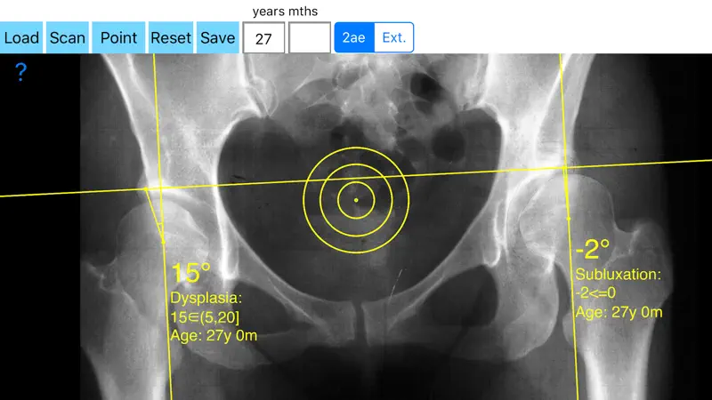 CenterEdgeAngleApp screenshot 1 of 5