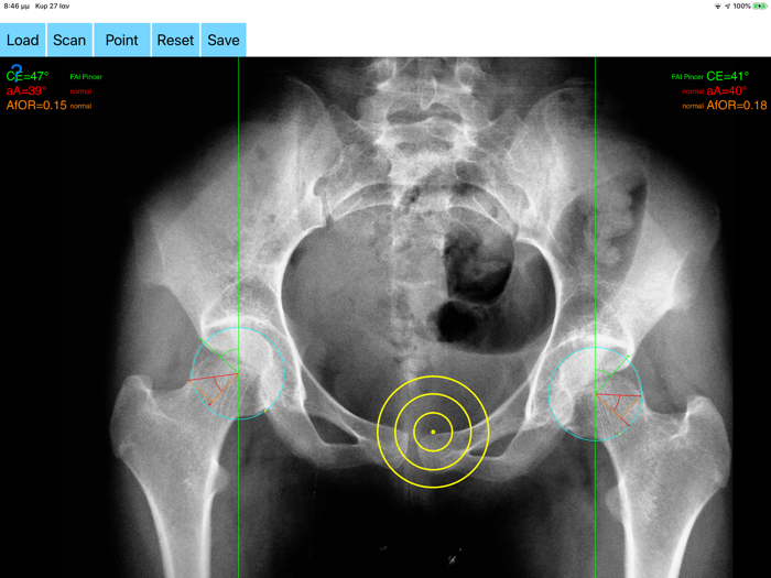 FemoroAcetabularImpingementApp