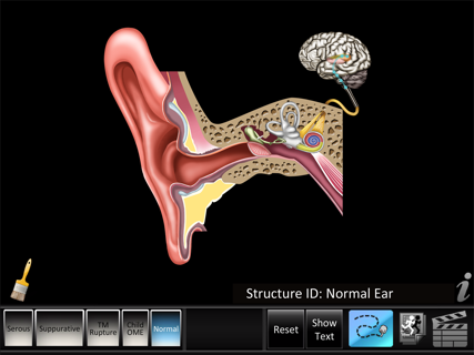 Otitis Media Disorders screenshot 6