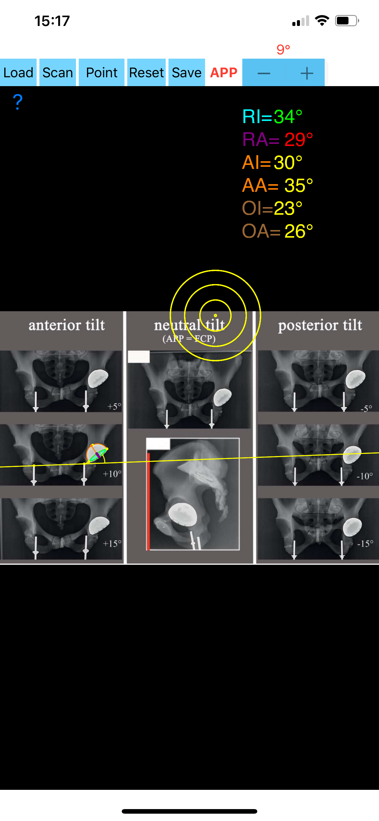 CupAnteversionInclinationApp