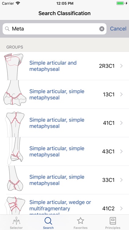 AO/OTA Fracture Classification