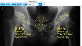 AcetabularDepthRatioApp screenshot