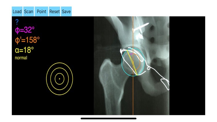 AcetabularAnteversionApp screenshot-6