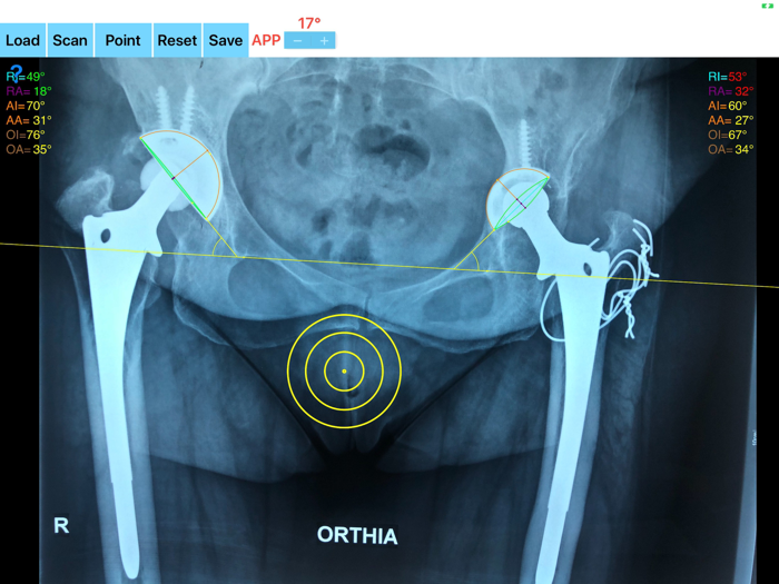 CupAnteversionInclinationApp