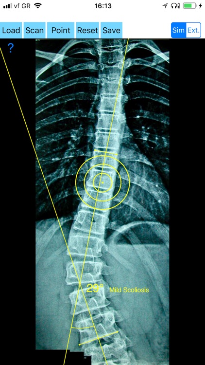 CobbAngleApp screenshot-0